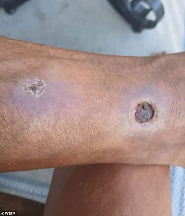 Florida Woman Files Urgent Lawsuit Against Apartment Complex Over Spider Infestation-Related Amputation