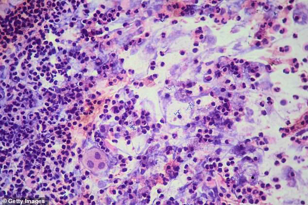 Deadly TB Outbreak at San Francisco's Archbishop Riordan High School Sparks Concerns Over Public Health Preparedness and Student Safety