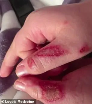 Nine-Year-Old Suffers Severe Burns Microwaving Needoh Cube in TikTok Trend