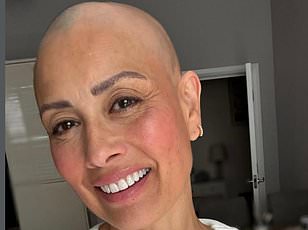Subtle Signs Like Excessive Shedding May Signal Early Alopecia