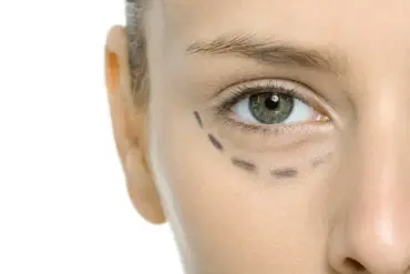 Eyelid Surgery: A Subtle Transformation Without the Need for a Full Facelift