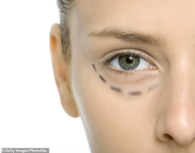 Eyelid Surgery: A Subtle Transformation Without the Need for a Full Facelift